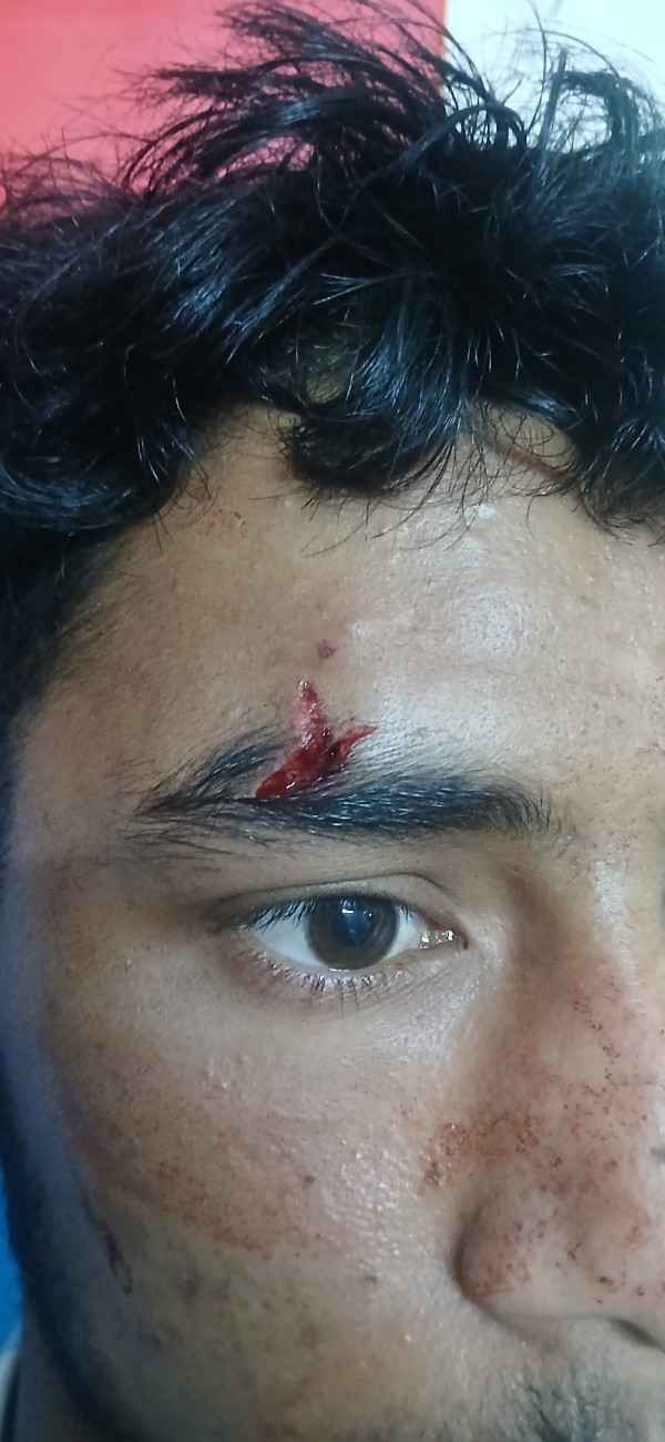 लोहाघाट महाविद्यालय में एबीवीपी व एनएसयूआई के बीच मारपीट एनएसयूआई छात्र नेता घायल।